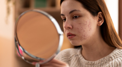 Polycystic Ovary Syndrome (PCOS), image of a young woman with acne on her face looking in a round mirror.