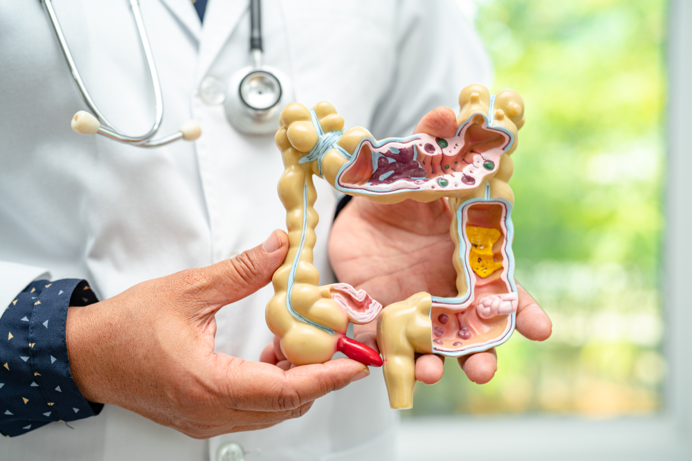 Inflammatory Bowel Disease (IBD), image of a doctor holding a model of the large intestine.